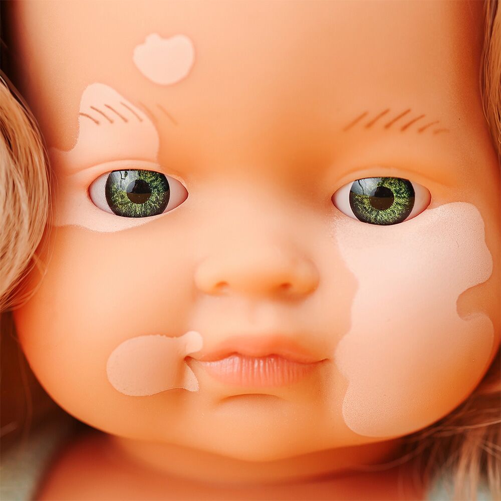 Baby Doll Girl with Vitiligo